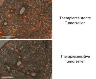 Lungenschnitte können mit Substanzen behandelt werden, um das Wachstumsverhalten von Tumorzellen in der Kultur zu untersuchen. Hier ist das Tumorzellwachstum nach 2 Tagen dargestellt. Die Tumorzellen sind rot markiert.